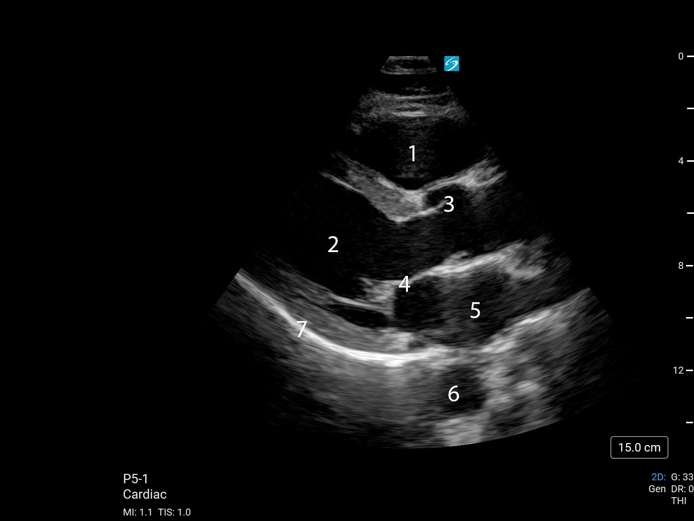 心臓傍胸骨長軸像（PLAX)2画像 | Sonosite Institute for Point-of